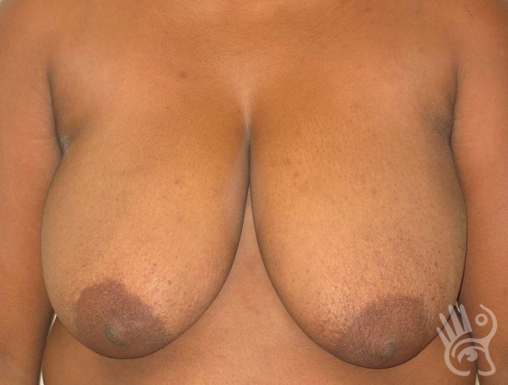 Breast Reduction