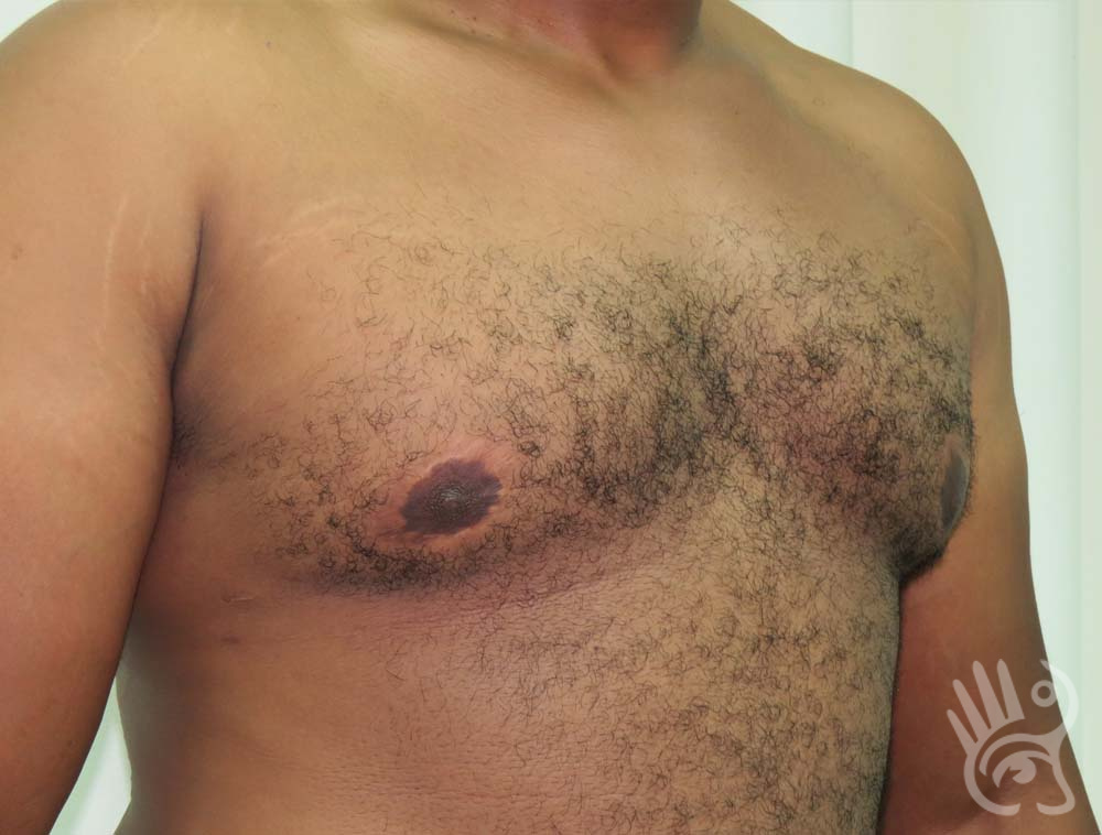 Gynaecomastia