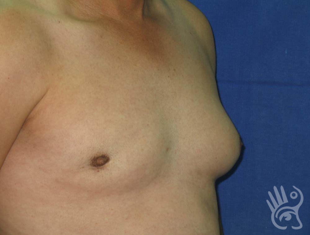 Gynaecomastia