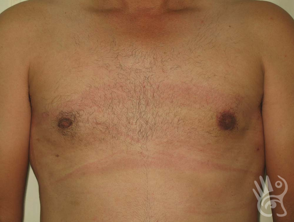 Gynaecomastia