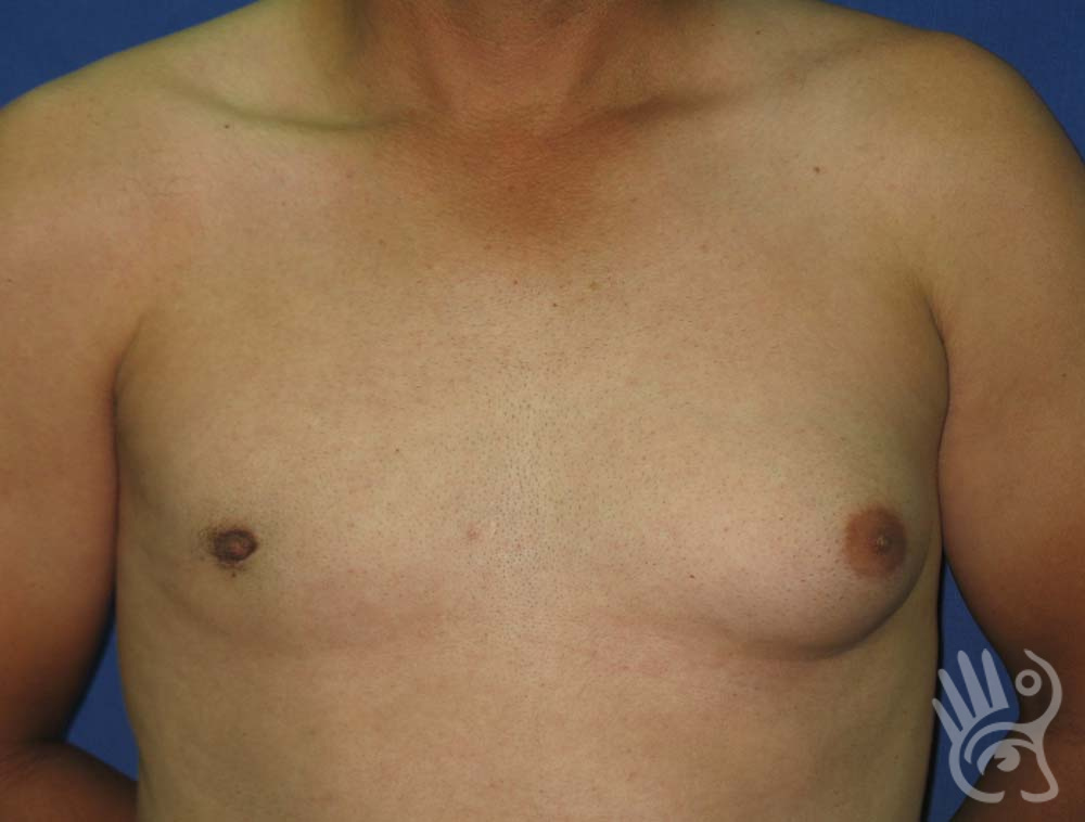 Gynaecomastia