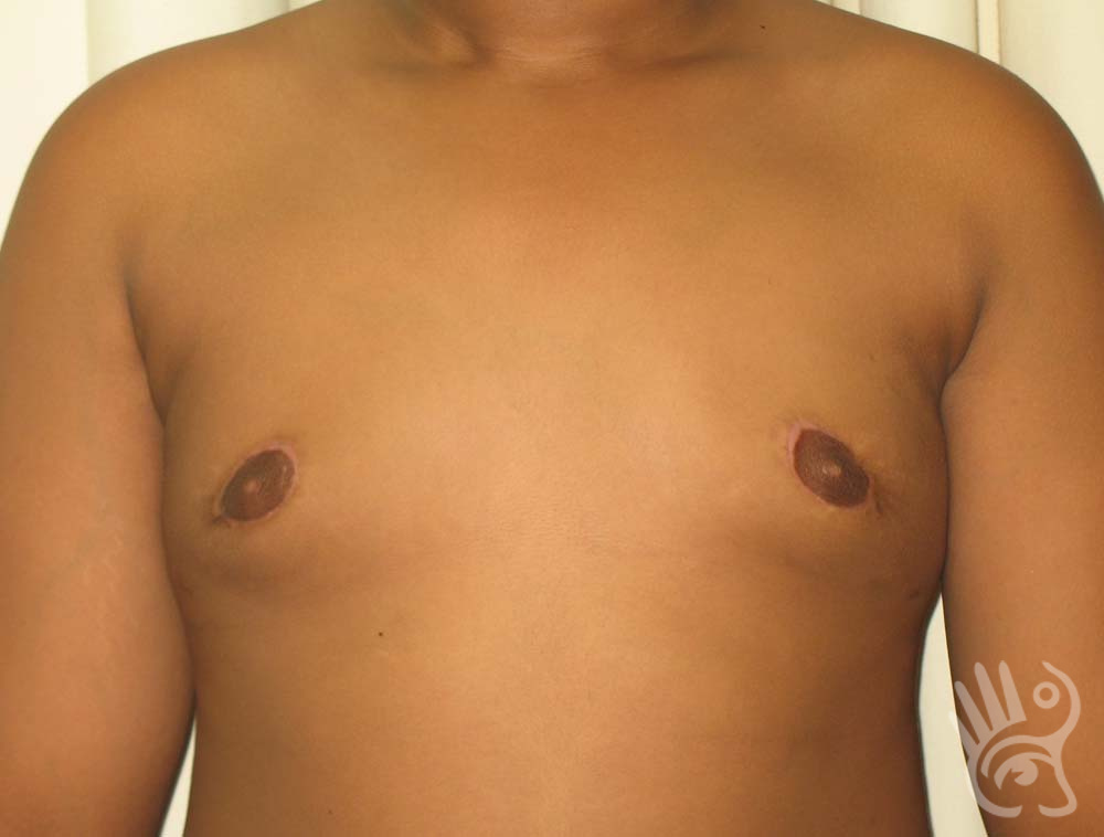 Gynaecomastia