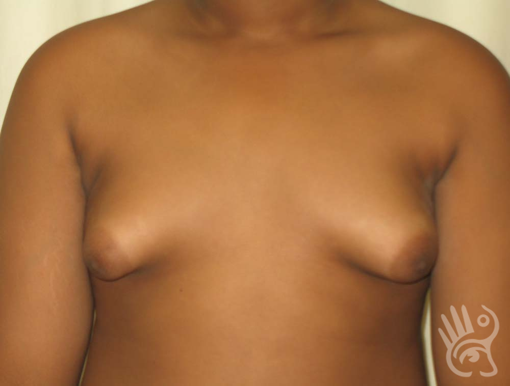 Gynaecomastia