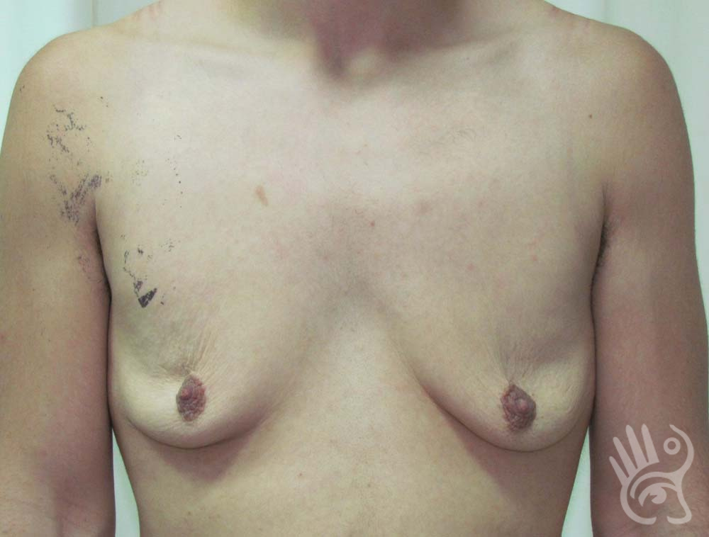 Gynaecomastia