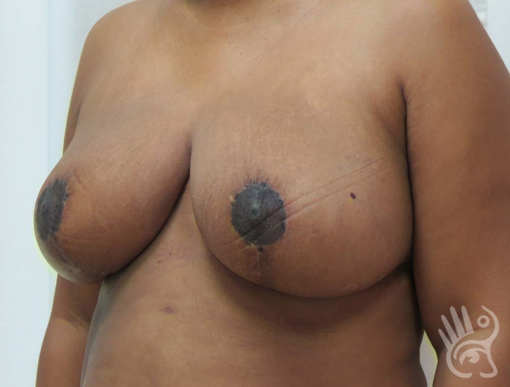 Breast Reduction