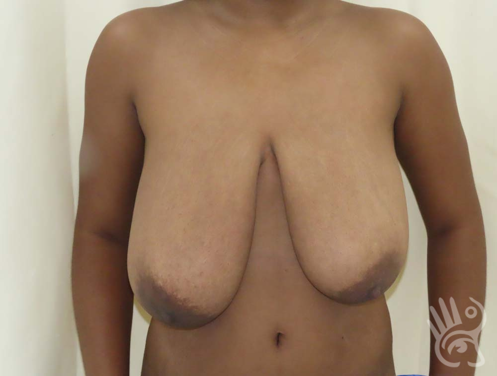 Breast Reduction