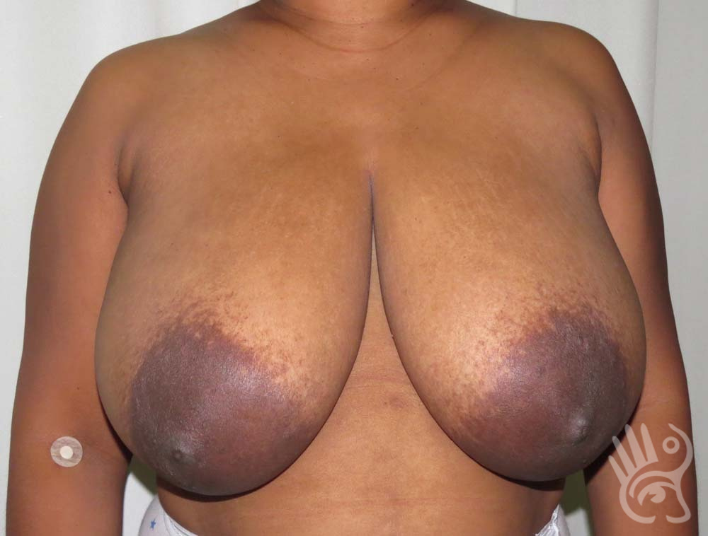 Breast Reduction