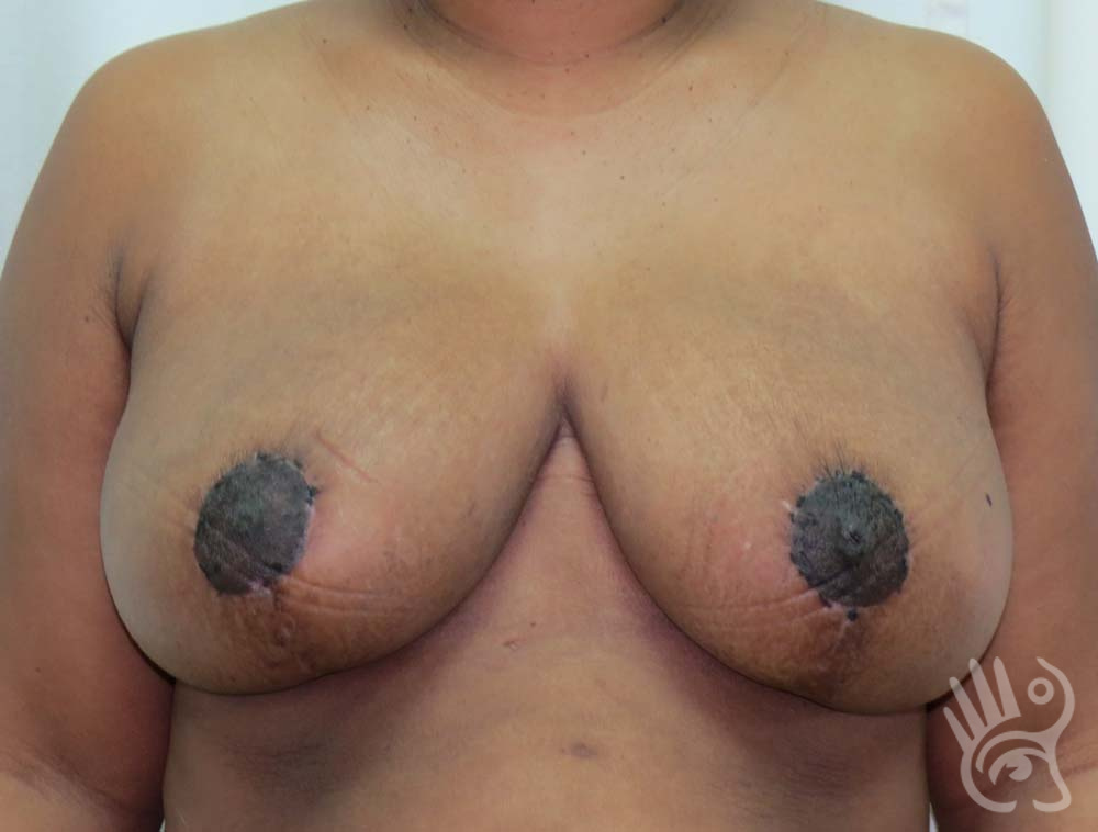 Breast Reduction