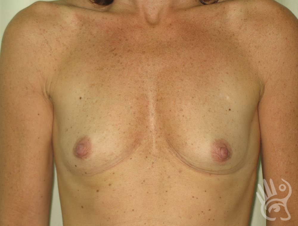 Breast Augmentation