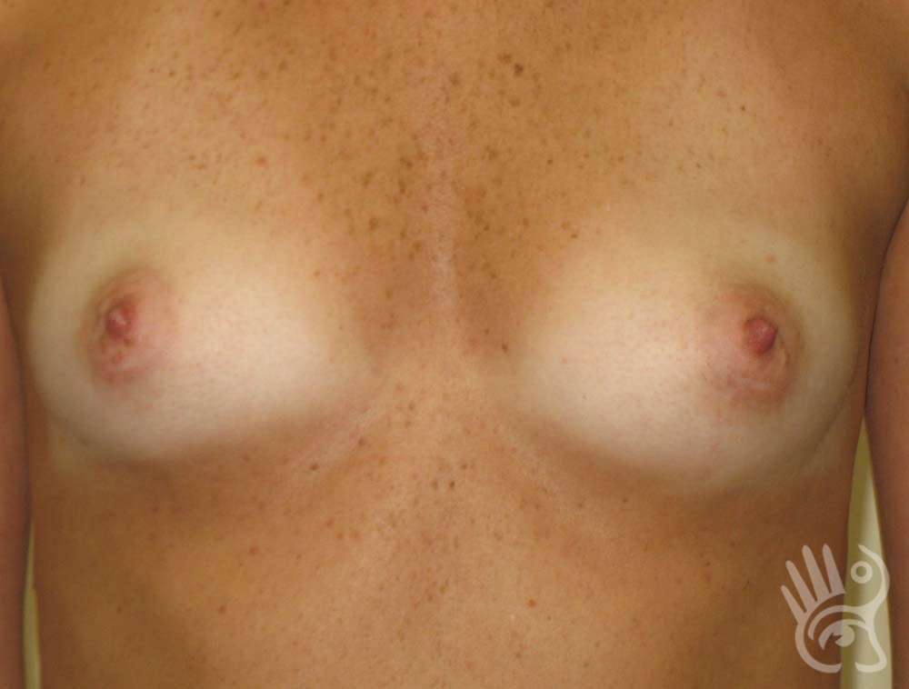 Breast Augmentation