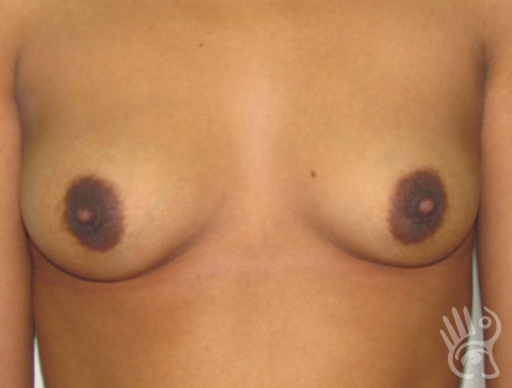 Breast Augmentation