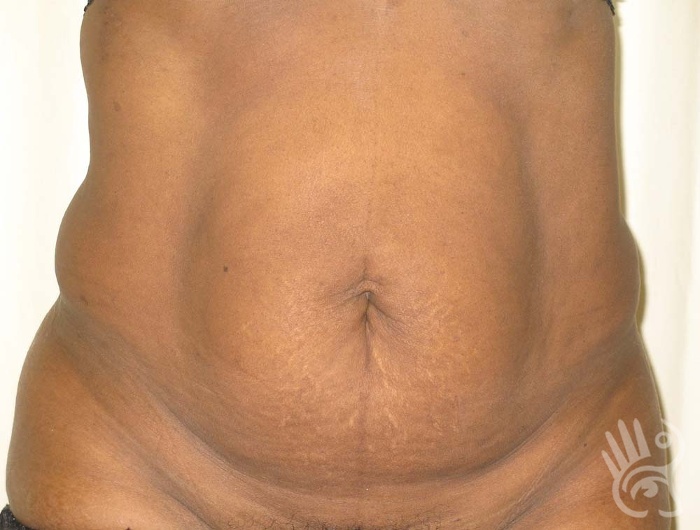 Abdominoplasty