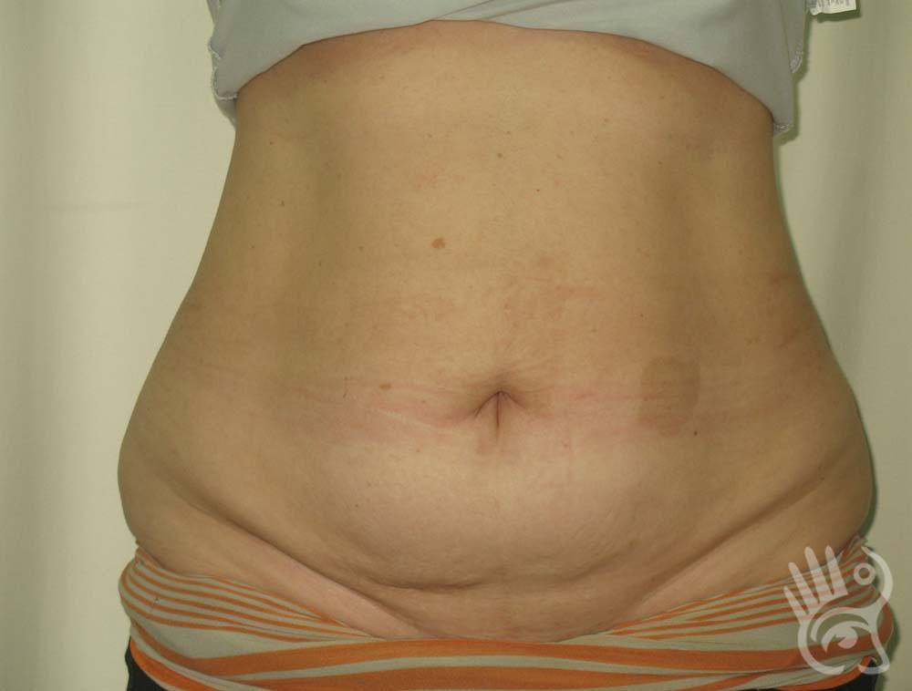 Abdominoplasty