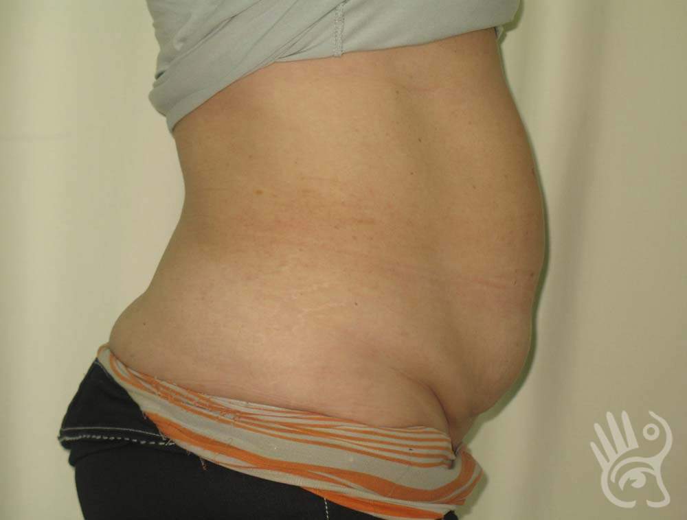 Abdominoplasty