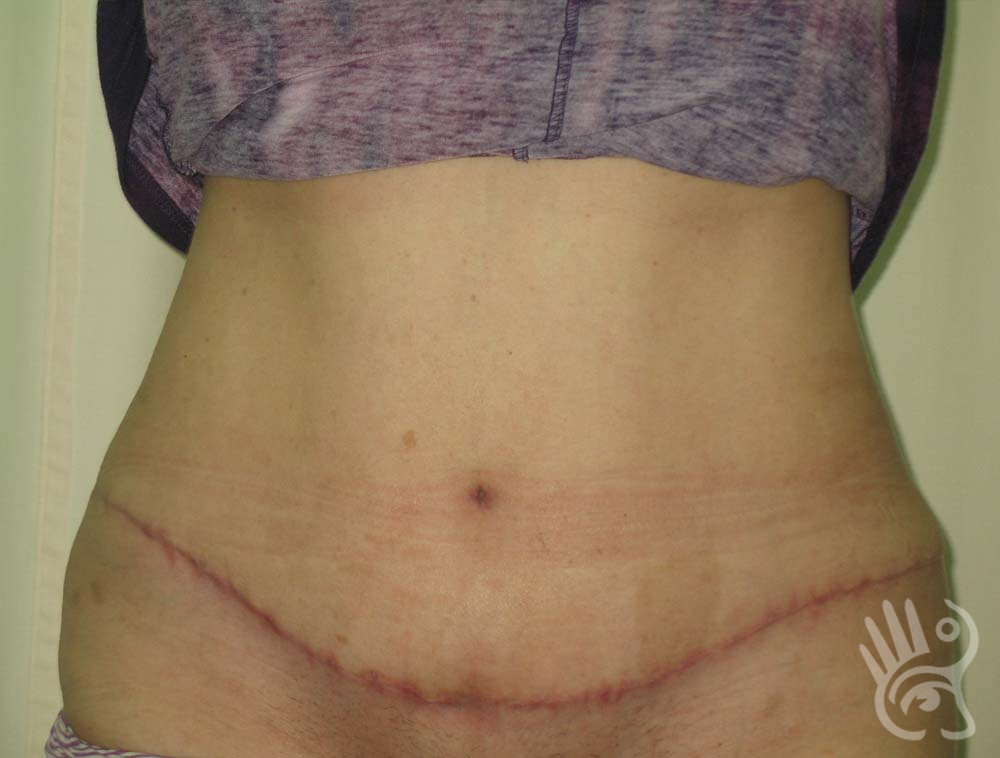 Abdominoplasty