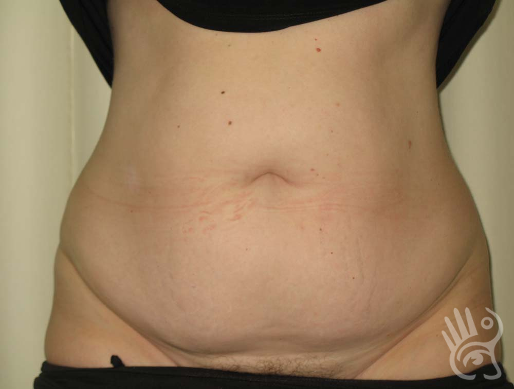 Abdominoplasty