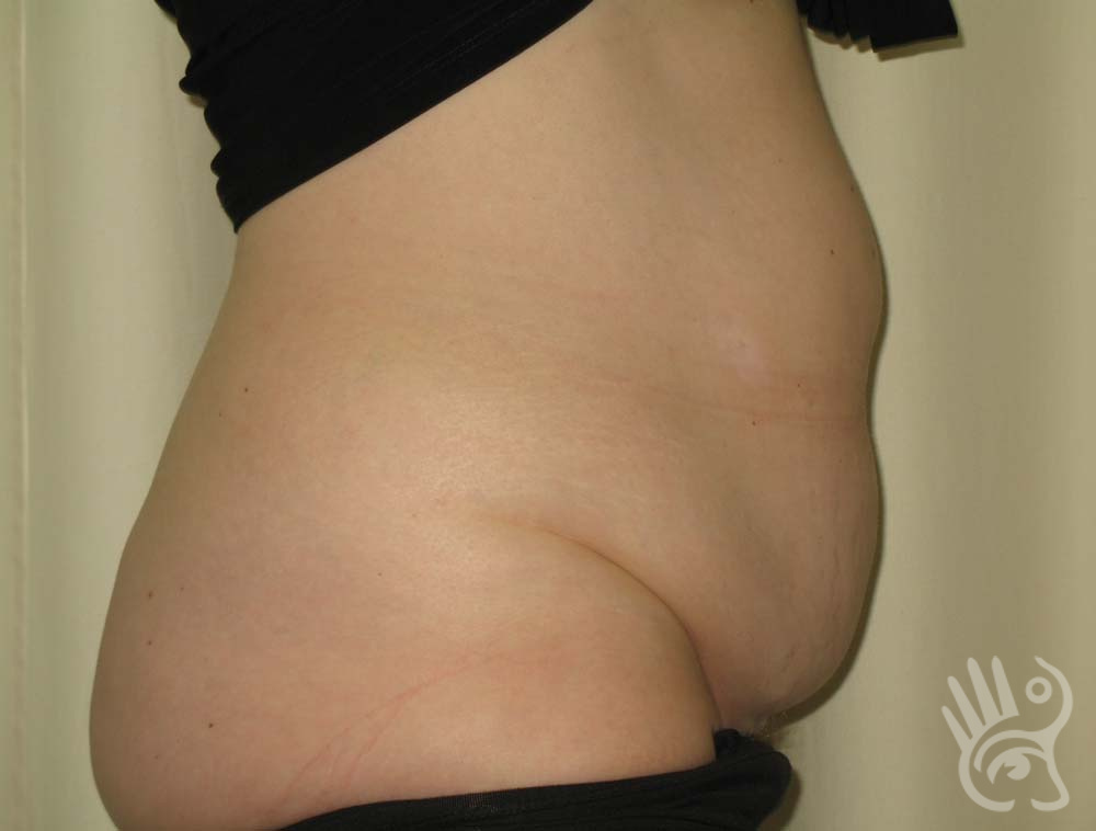 Abdominoplasty