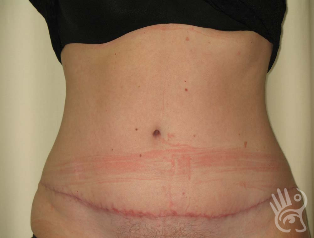 Week 2 post op follow up after double reverse abdominoplasty for isola