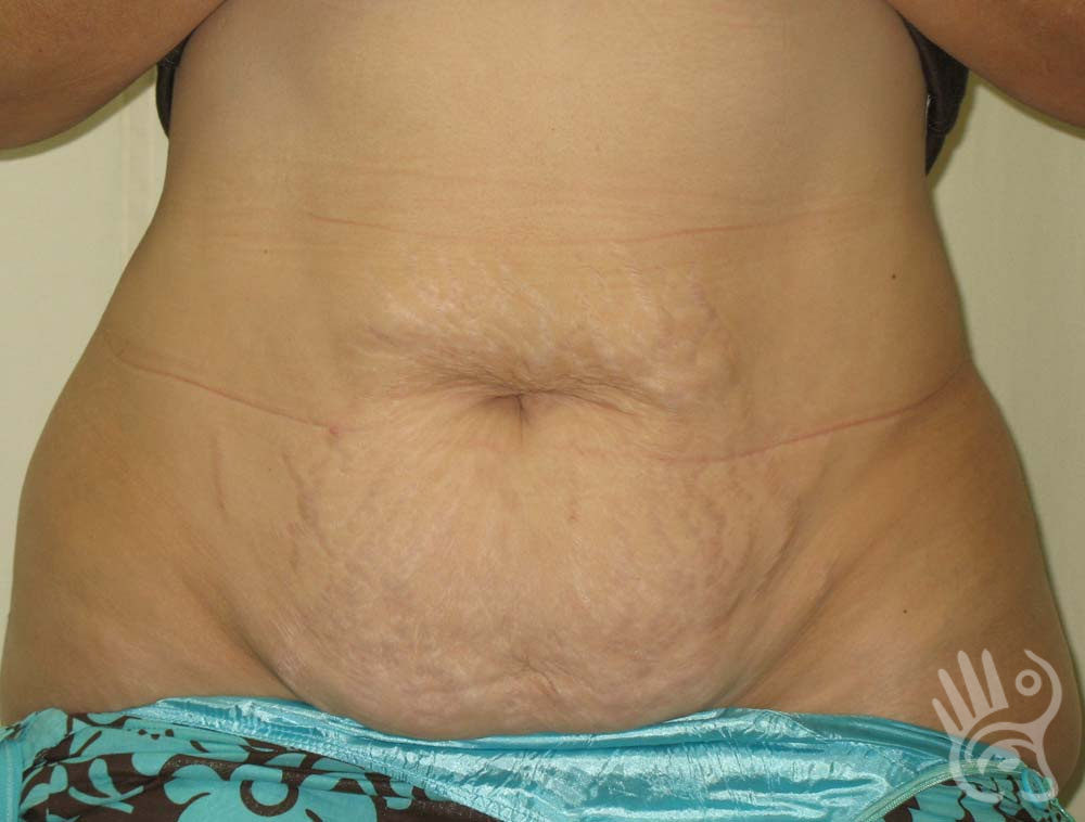 Abdominoplasty