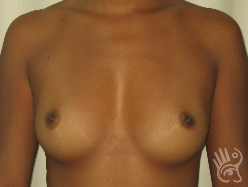 Breast Augmentation