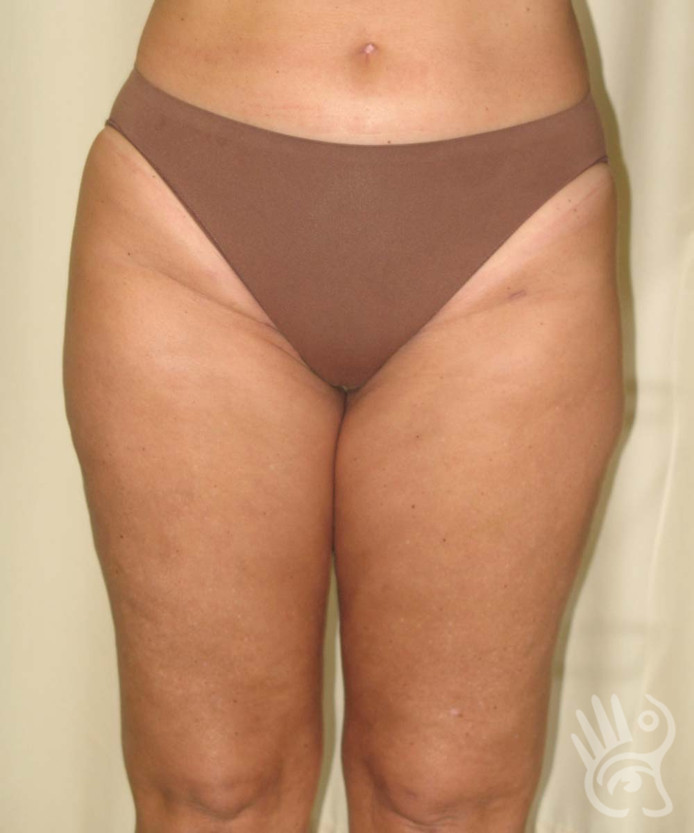 Liposuction