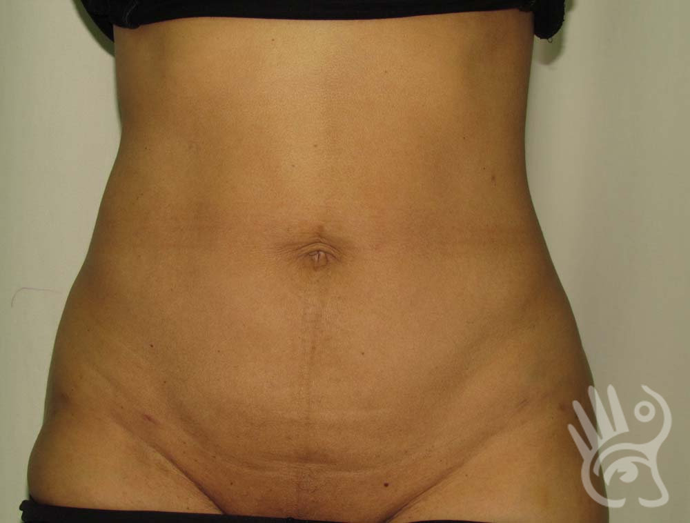 Liposuction