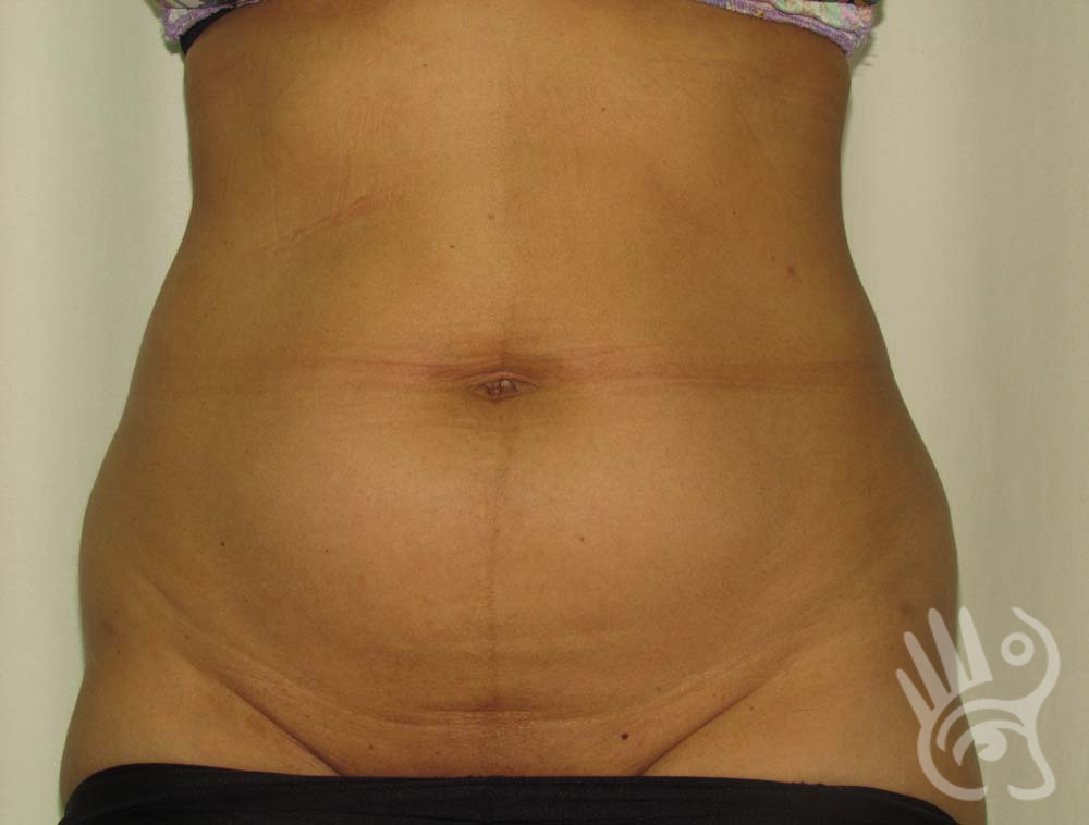 Liposuction