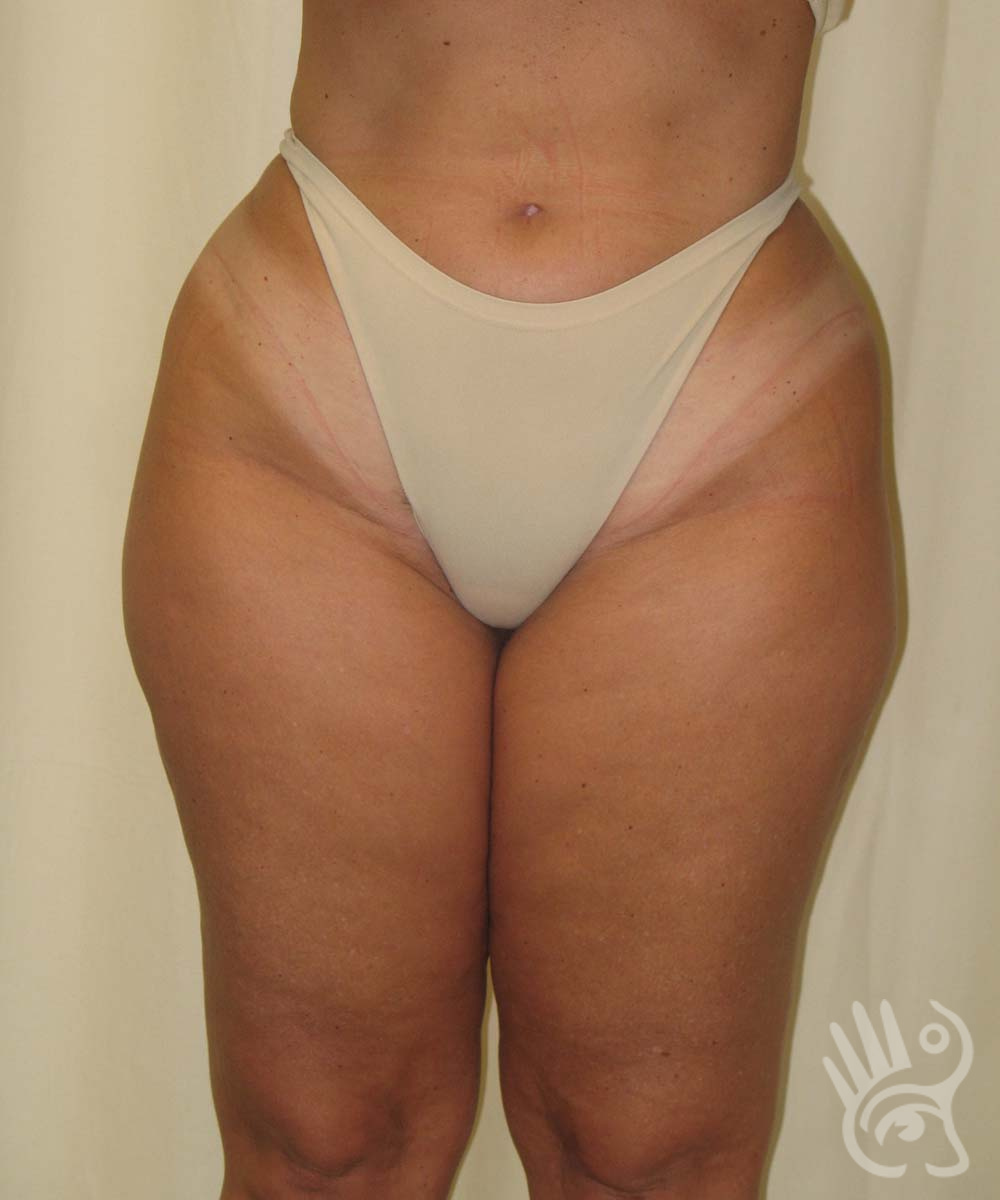 Liposuction