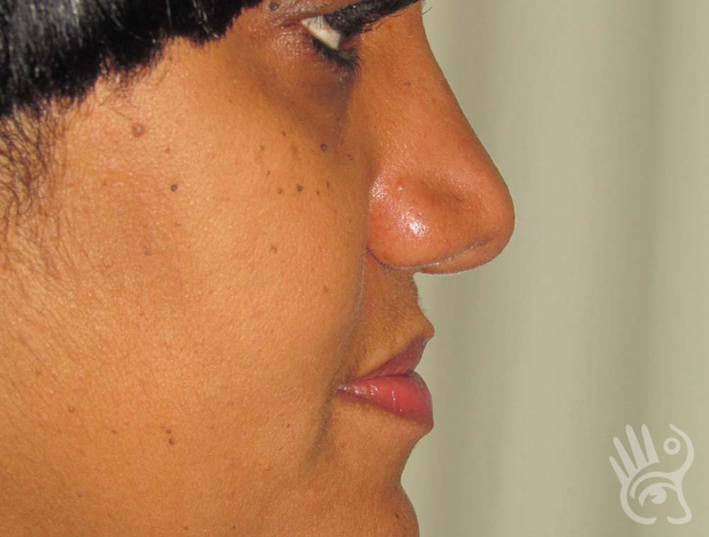 Rhinoplasty