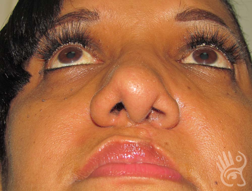 Rhinoplasty