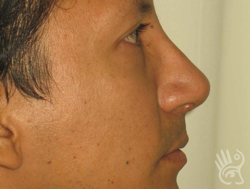 Rhinoplasty