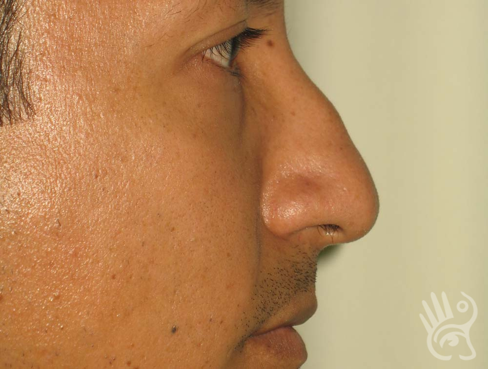 Rhinoplasty