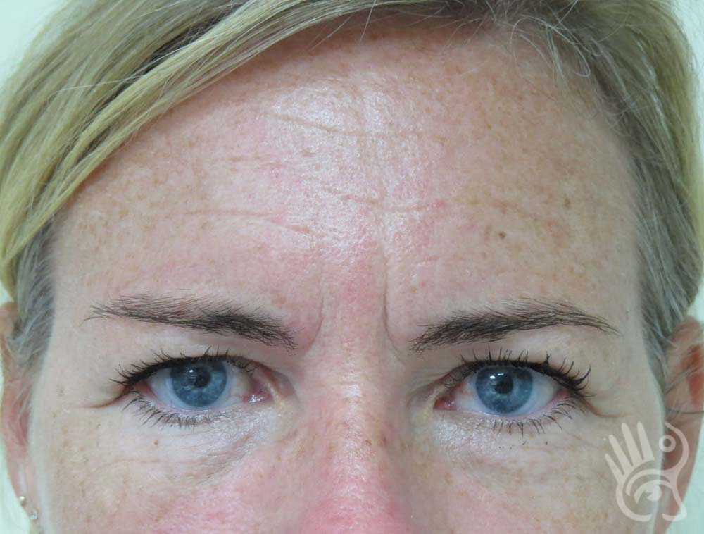 Forehead Lift